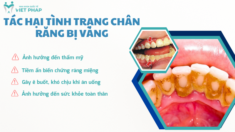 Tác hại tình trạng chân răng bị vàng