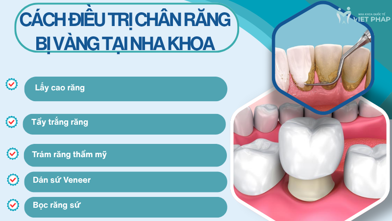 Cách điều trị chân răng bị vàng tại nha khoa