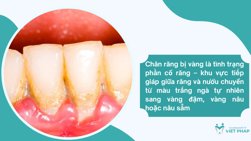 Chân răng bị vàng là tình trạng phần cổ răng – khu vực tiếp giáp giữa răng và nướu chuyển từ màu trắng ngà tự nhiên sang vàng đậm, vàng nâu hoặc nâu sẫm