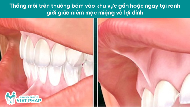 Thắng môi trên thường bám vào khu vực gần hoặc ngay tại ranh giới giữa niêm mạc miệng và lợi dính