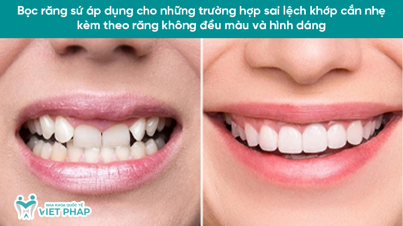 Sai lech khop can 7 Bọc răng sứ áp dụng cho những trường hợp sai lệch khớp cắn nhẹ kèm theo răng không đều màu và hình dáng