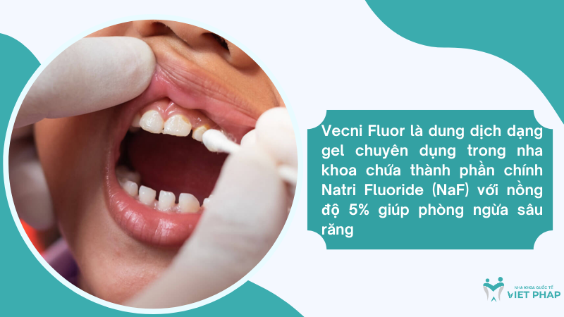 Vecni Fluor là dung dịch dạng gel chuyên dụng trong nha khoa chứa thành phần chính  Natri Fluoride (NaF) với nồng độ 5% giúp phòng ngừa sâu răng