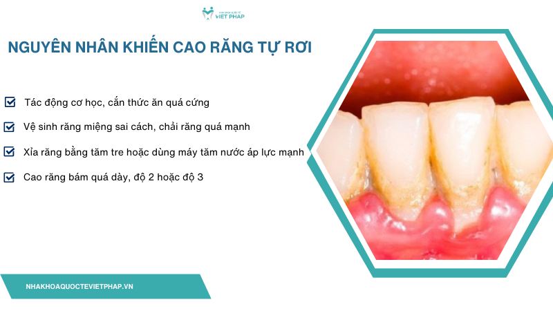 cao rang tu roi ra co tot khong 2 Nguyên nhân khiến cao răng tự rơi