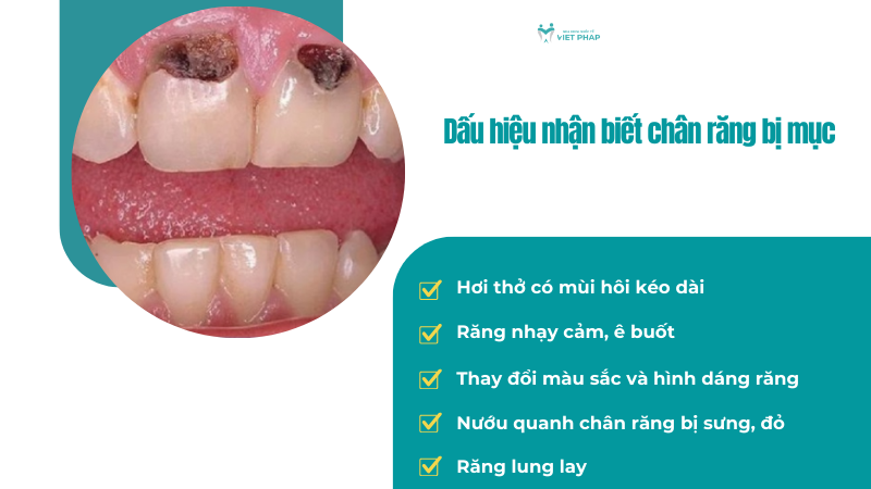 Dấu hiệu nhận biết chân răng bị mục