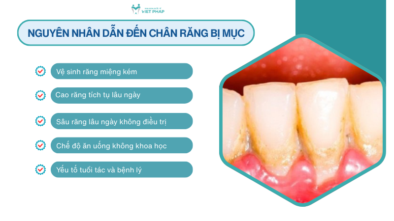 Nguyên nhân dẫn đến chân răng bị mục