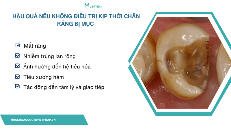 Hậu quả nếu không điều trị kịp thời chân răng bị mục