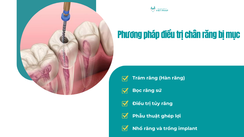 Phương pháp điều trị chân răng bị mục
