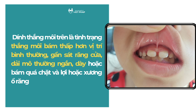 Dính thắng môi trên là tình trạng thắng môi bám thấp hơn vị trí bình thường, gần sát răng cửa, dải mô thường ngắn, dày hoặc bám quá chặt và lợi hoặc xương ổ răng