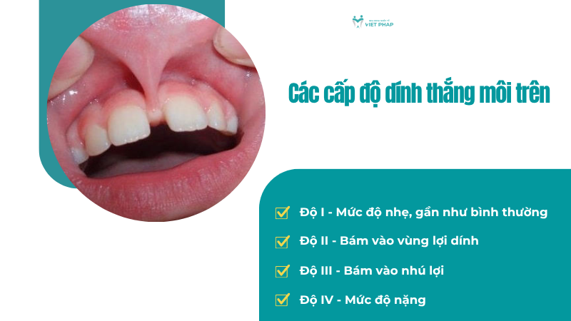 Các cấp độ dính thắng môi trên