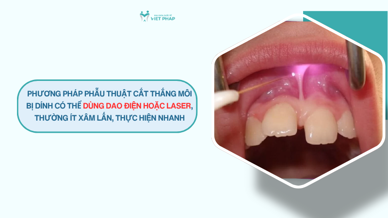 Phương pháp phẫu thuật cắt thắng môi bị dính có thể dùng dao điện hoặc laser, thường ít xâm lấn, thực hiện nhanh