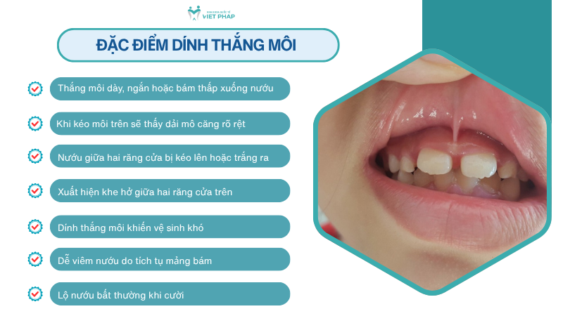 dinh thang moi va moi binh thuong 2 Đặc điểm dính thắng môi