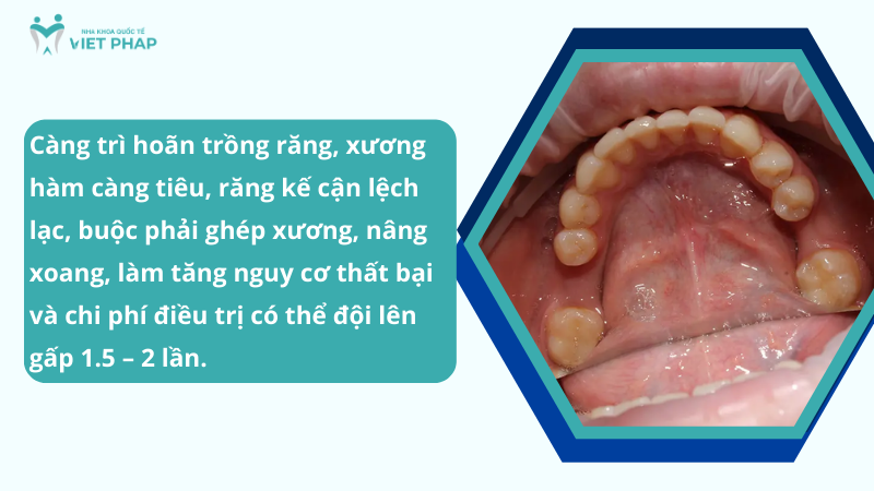 khong trong rang co sao khong 5 Càng trì hoãn trồng răng, xương hàm càng tiêu, răng kế cận lệch lạc, buộc phải ghép xương – nâng xoang phức tạp, làm tăng nguy cơ thất bại và chi phí điều trị có thể đội lên gấp 1.5–2 lần