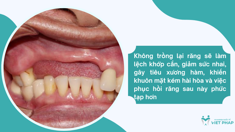khong trong rang co sao khong Không trồng lại răng sẽ làm lệch khớp cắn, giảm sức nhai, gây tiêu xương hàm, khiến khuôn mặt kém hài hòa và việc phục hồi răng sau này phức tạp hơn