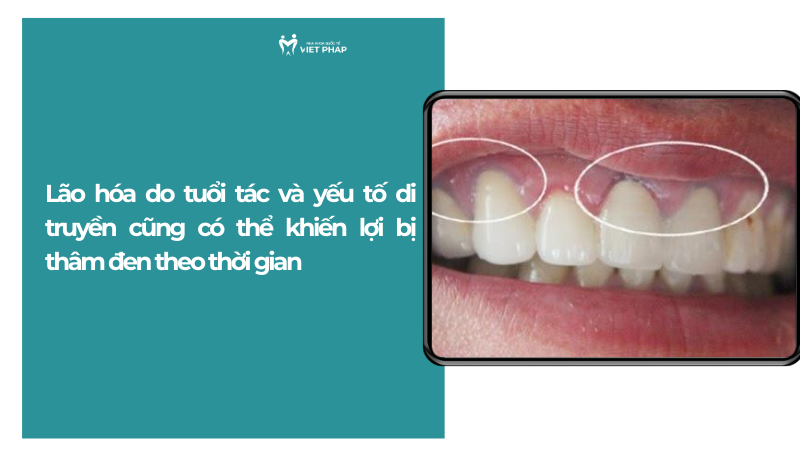 Lão hóa do tuổi tác và yếu tố di truyền cũng có thể khiến lợi bị thâm đen theo thời gian