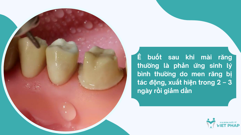 Ê buốt sau khi mài răng thường là phản ứng sinh lý bình thường do men răng bị tác động, xuất hiện trong 2 – 3 ngày rồi giảm dần