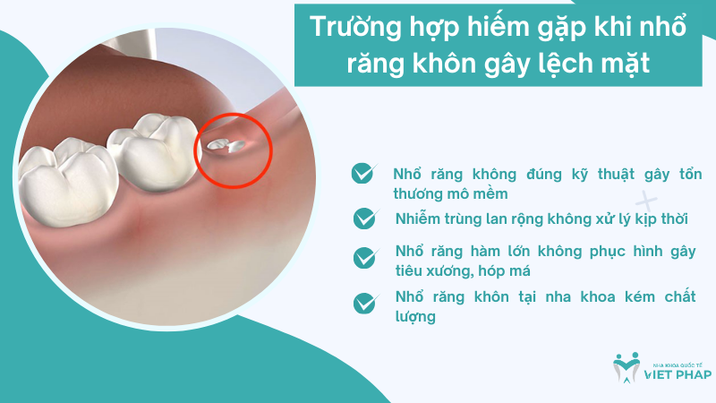 Trường hợp hiếm gặp khi nhổ răng khôn gây lệch mặt
