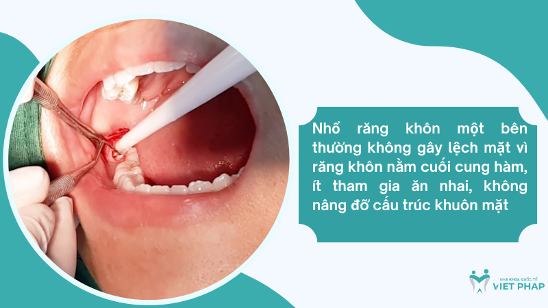 Nhổ răng khôn một bên thường không gây lệch mặt vì răng khôn nằm cuối cung hàm, ít tham gia ăn nhai, không nâng đỡ cấu trúc khuôn mặt