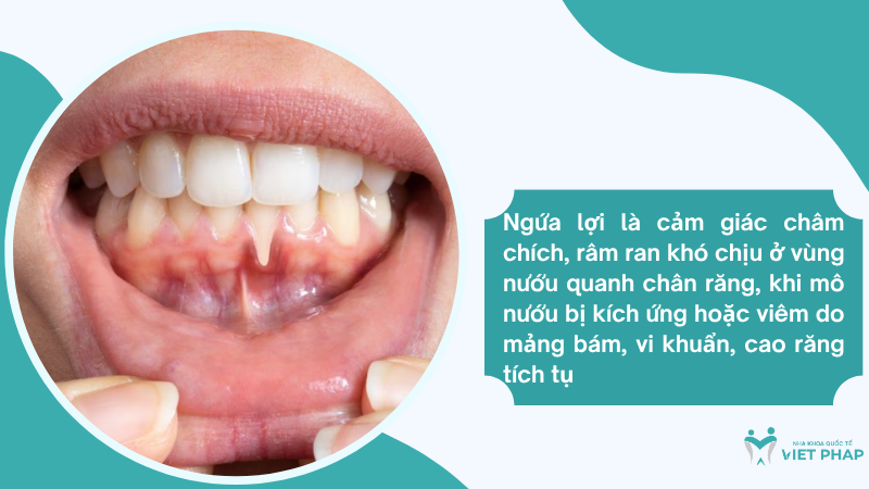 Ngứa lợi là cảm giác châm chích, râm ran khó chịu ở vùng nướu quanh chân răng, khi mô nướu bị kích ứng hoặc viêm do mảng bám, vi khuẩn, cao răng tích tụ