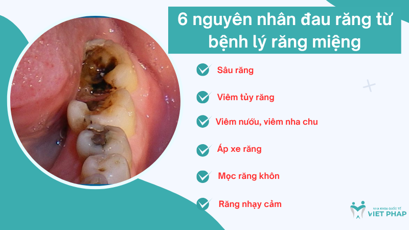 6 nguyên nhân đau răng từ bệnh lý răng miệng