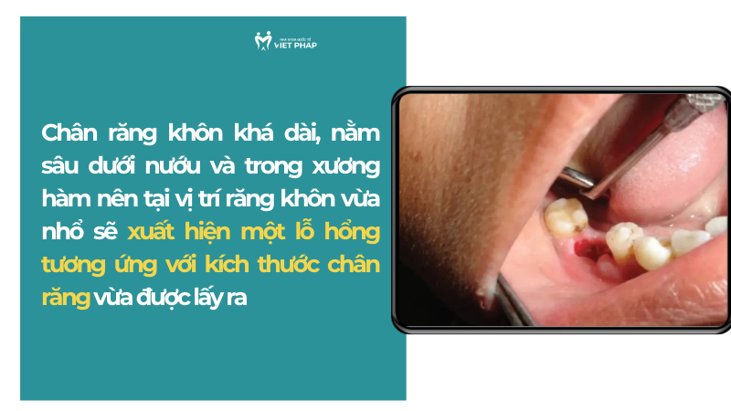 Chân răng khôn khá dài, nằm sâu dưới nướu và trong xương hàm nên tại vị trí răng khôn vừa nhổ sẽ xuất hiện một lỗ hổng tương ứng với kích thước chân răng vừa được lấy ra