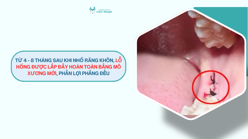 Từ 4 - 8 tháng sau khi nhổ răng khôn, lỗ hổng được lấp đầy hoàn toàn bằng mô xương mới, phần lợi phẳng đều