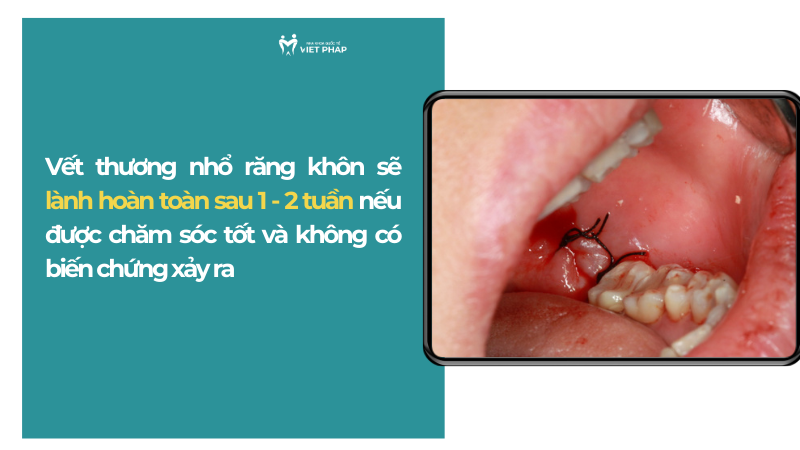 Vết thương nhổ răng khôn sẽ lành hoàn toàn sau 1 - 2 tuần nếu được chăm sóc tốt và không có biến chứng xảy ra