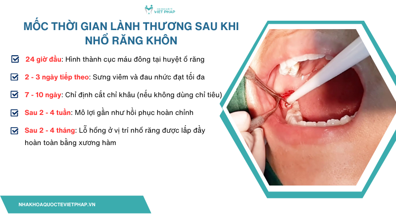 Mốc thời gian lành thương sau khi nhổ răng khôn