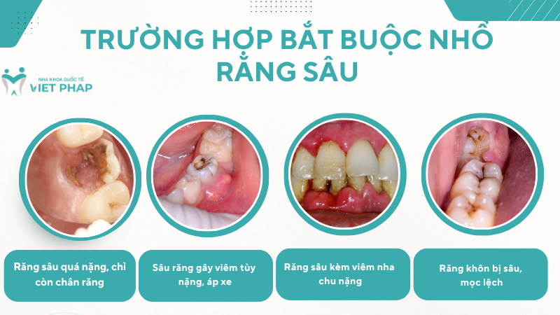 Trường hợp bắt buộc nhổ răng sâu