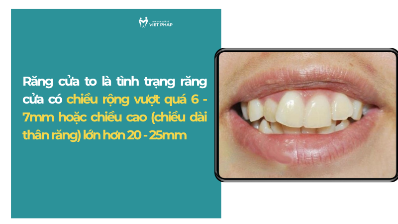Răng cửa to là tình trạng răng cửa có chiều rộng vượt quá 6 - 7mm hoặc chiều cao (chiều dài thân răng) lớn hơn 20 - 25mm