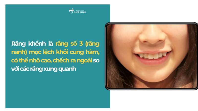 rang khenh 1 Răng khểnh là răng số 3 (răng nanh) mọc lệch khỏi cung hàm, có thể nhô cao, chếch ra ngoài so với các răng xung quanh