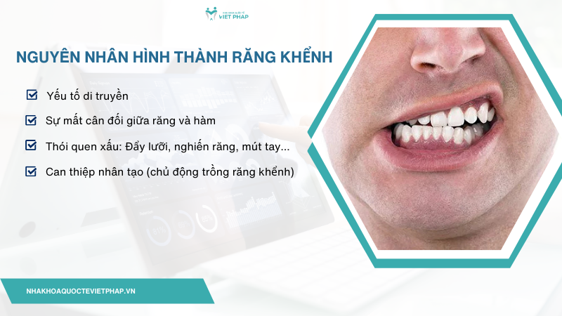 rang khenh 2 Nguyên nhân hình thành răng khểnh