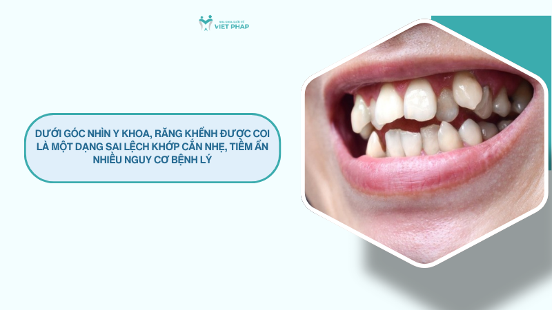 rang khenh 3 Dưới góc nhìn y khoa, răng khểnh được coi là một dạng sai lệch khớp cắn nhẹ, tiềm ẩn nhiều nguy cơ bệnh lý