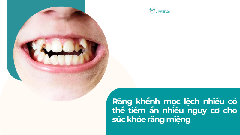 rang khenh 4 Răng khểnh mọc lệch nhiều có thể tiềm ẩn nhiều nguy cơ cho sức khỏe răng miệng