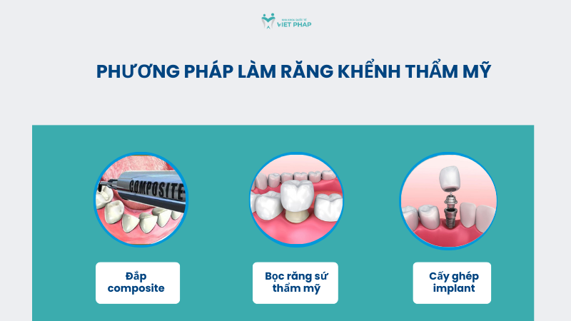rang khenh 6 Phương pháp làm răng khểnh thẩm mỹ