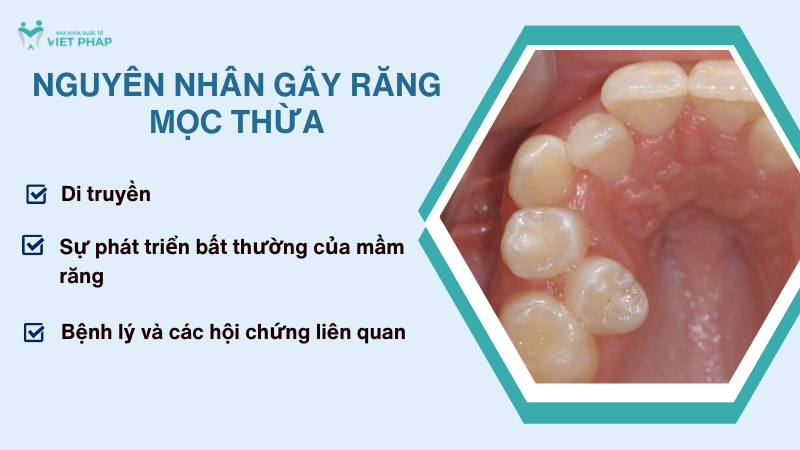 rang moc thua 3 Nguyên nhân gây răng mọc thừa