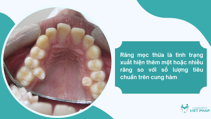 rang moc thua Răng mọc thừa là tình trạng xuất hiện thêm một hoặc nhiều răng so với số lượng tiêu chuẩn trên cung hàm