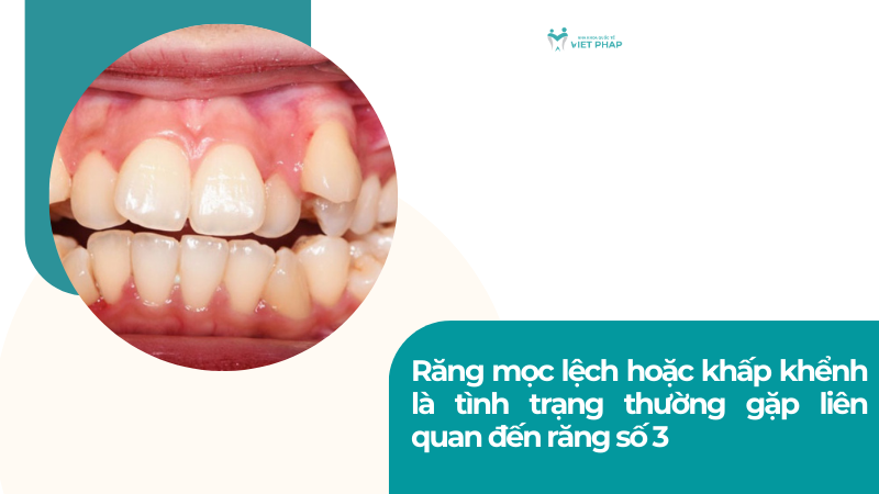 Răng mọc lệch hoặc khấp khểnh là tình trạng thường gặp liên quan đến răng số 3