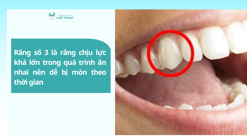 Răng số 3 là răng chịu lực khá lớn trong quá trình ăn nhai nên dễ bị mòn theo thời gian