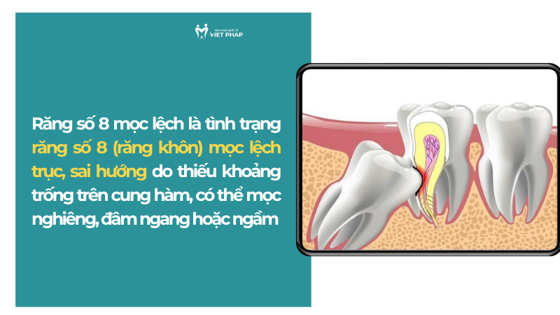 Răng số 8 mọc lệch là tình trạng răng số 8 (răng khôn) mọc lệch trục, sai hướng do thiếu khoảng trống trên cung hàm, có thể mọc nghiêng, đâm ngang hoặc ngầm