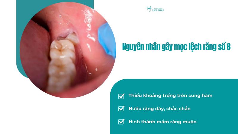 Nguyên nhân gây mọc lệch răng số 8