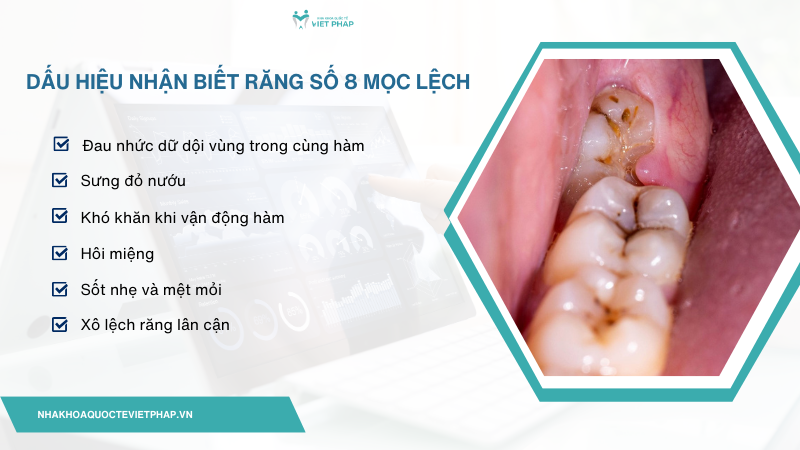 Dấu hiệu nhận biết răng số 8 mọc lệch