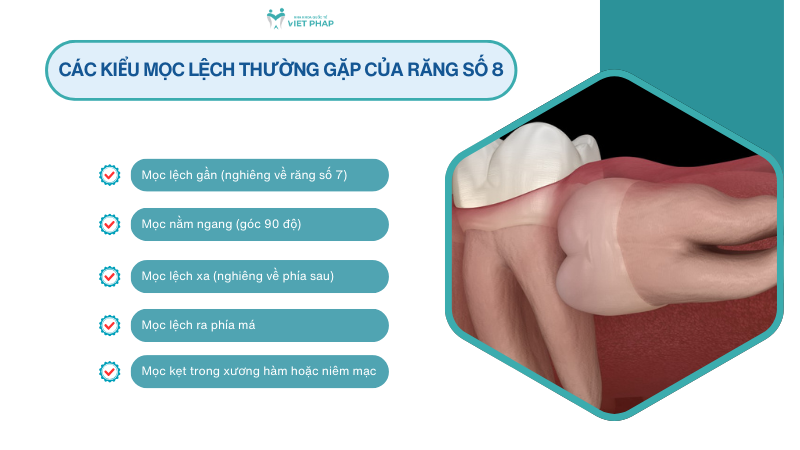 Các kiểu mọc lệch thường gặp của răng số 8