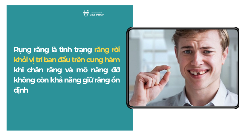 Rụng răng là tình trạng răng rời khỏi vị trí ban đầu trên cung hàm khi chân răng và mô nâng đỡ không còn khả năng giữ răng ổn định