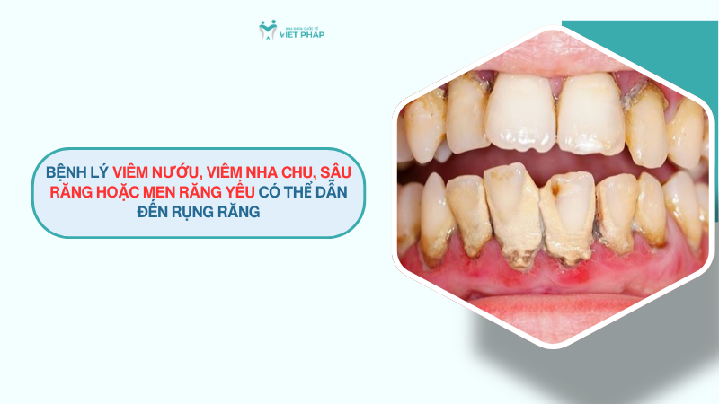 Bệnh lý viêm nướu, viêm nha chu, sâu răng hoặc men răng yếu có thể dẫn đến rụng răng