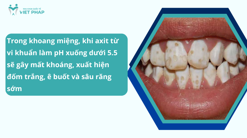 tai khoang rang 2 Trong khoang miệng, khi axit từ vi khuẩn làm pH xuống dưới 5.5 sẽ gây mất khoáng, xuất hiện đốm trắng, ê buốt và sâu răng sớm
