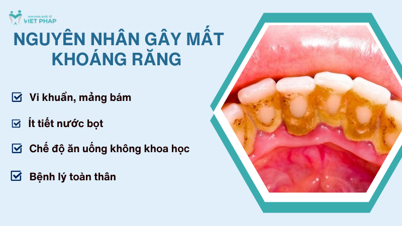tai khoang rang 4 Nguyên nhân gây mất khoáng răng