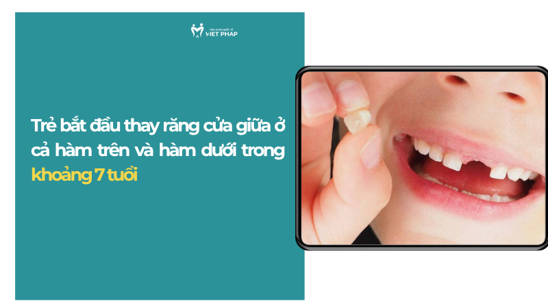 thay rang cua 1 Trẻ bắt đầu thay răng cửa giữa ở cả hàm trên và hàm dưới trong khoảng 7 tuổi