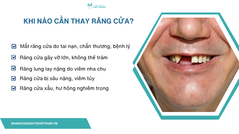 thay rang cua 3 Khi nào cần thay răng cửa?