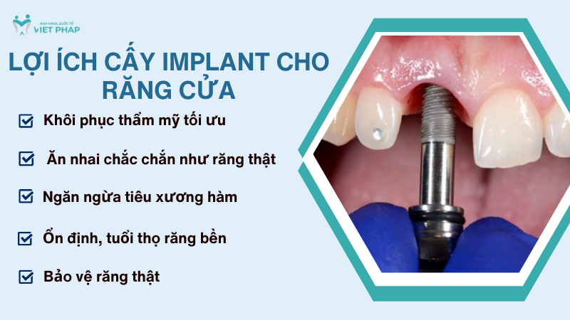 Lợi ích cấy Implant cho răng cửa