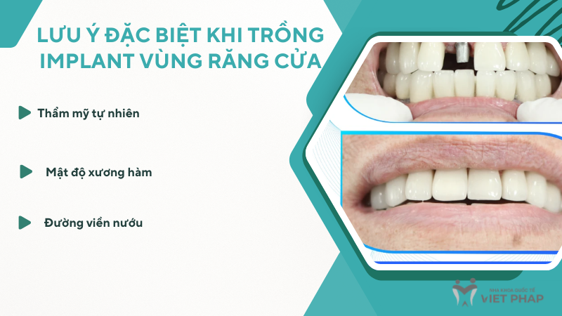 Lưu ý đặc biệt khi trồng Implant vùng răng cửa